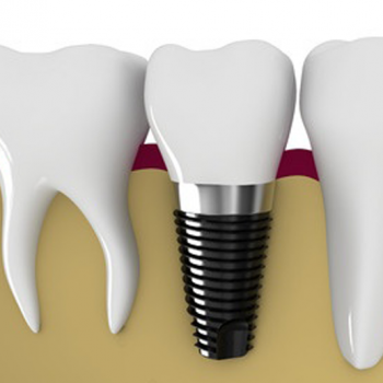 denture denture